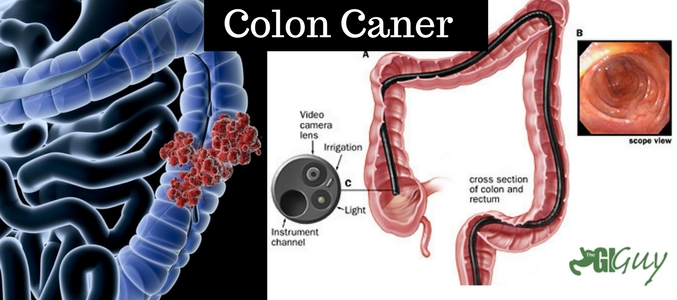 5 Advantages Of Getting a Colonoscopy Done - Dr Kurt Vernon at NC