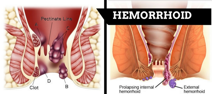 hemorrhoid removal in garner nc
